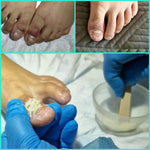 exudate control powder for neudebri