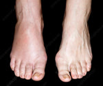 Foot Management